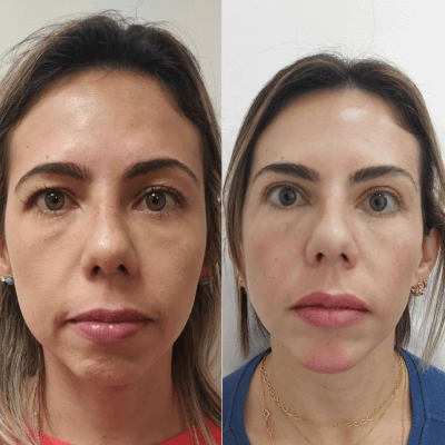 Harmonizacao-facial-Dra.-Larissa-antes-e-depois-1.png