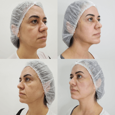Harmonizacao-facial-Dra.-Larissa-antes-e-depois-11.png