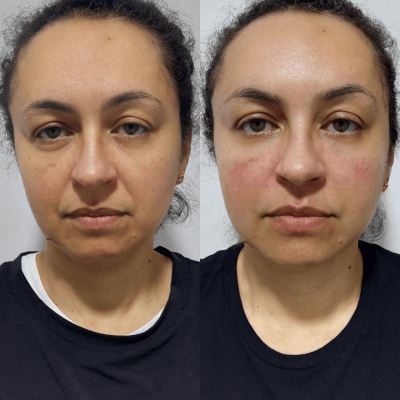 Harmonizacao-facial-Dra.-Larissa-antes-e-depois-2.png