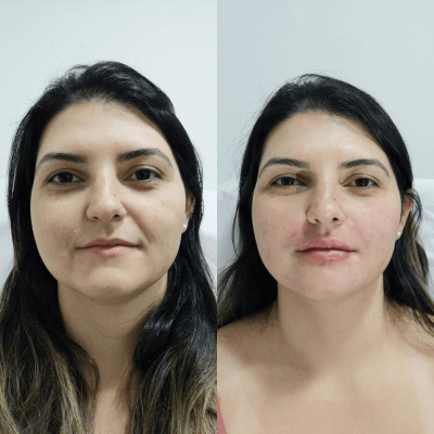 Harmonizacao-facial-Dra.-Larissa-antes-e-depois-3.png