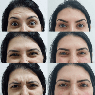 Harmonizacao-facial-Dra.-Larissa-antes-e-depois-4.png