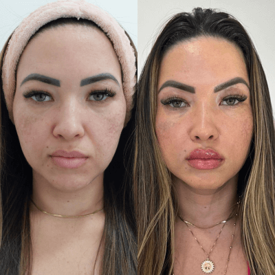 Harmonizacao-facial-Dra.-Larissa-antes-e-depois-5.png
