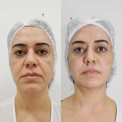 Harmonizacao-facial-Dra.-Larissa-antes-e-depois-6.png