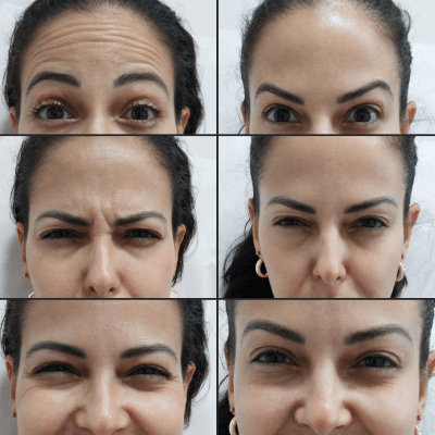 Harmonizacao-facial-Dra.-Larissa-antes-e-depois-7.png